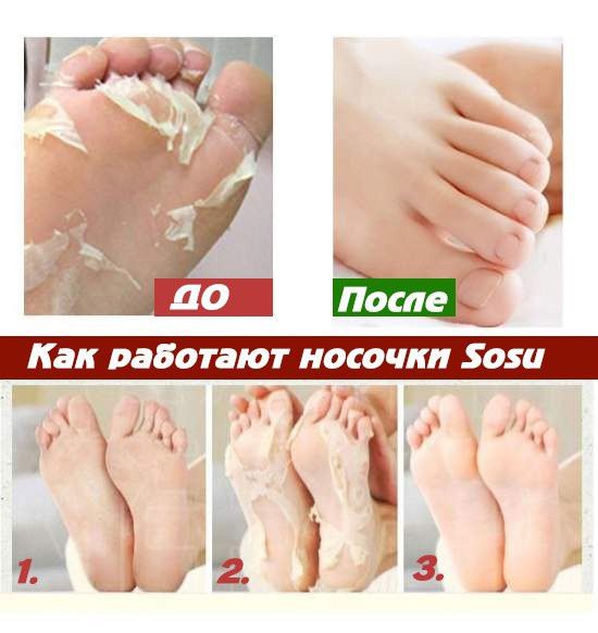 Носочки SOSU для пилинга и педикюра
