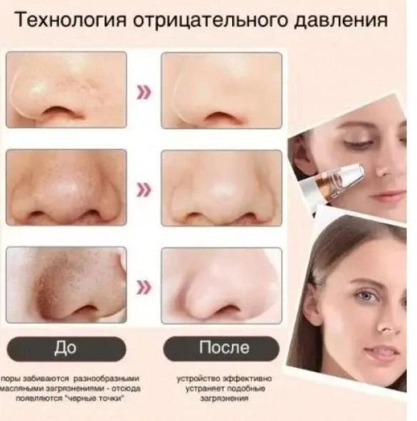 Вакуумный аппарат очиститель кожи и пор Multi-Functional для чистки лица, Аппарат для глубокой вакуумной чистки пор, Безболезненно удаляет угри, комедоны, акне, прыщи, предотвращая их появление,Убирает черные точки,Беспроводной очиститель лица